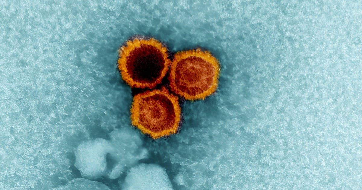 Study Links Common Epstein-Barr Virus to Lupus Development