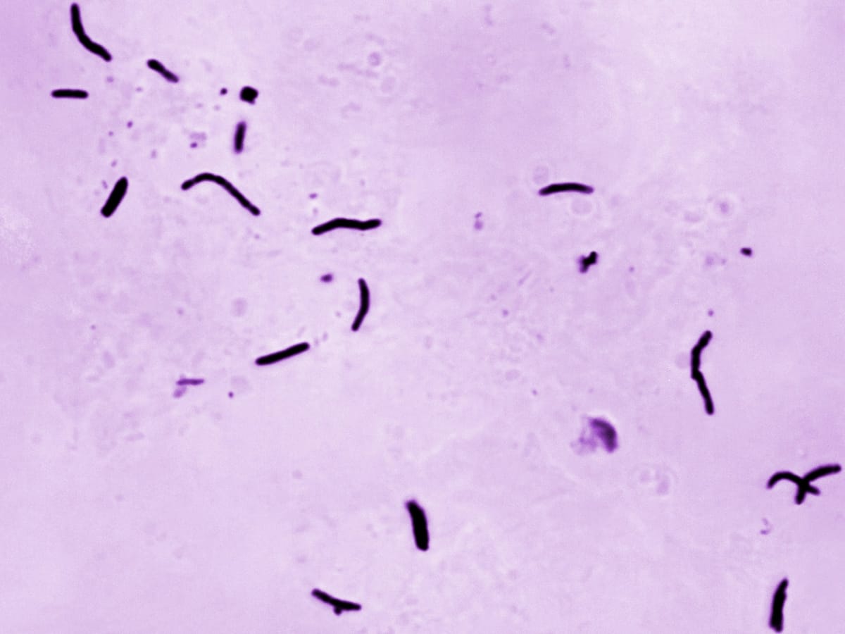 WHO reports 1.23 million TB deaths in 2024, a 3% decline