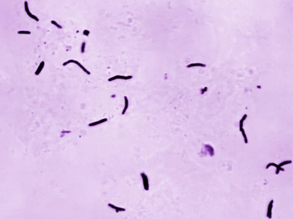 WHO reports 1.23 million TB deaths in 2024, a 3% decline